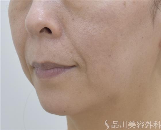 症例NO.48021のBEFORE写真