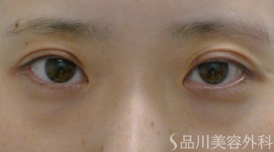 症例NO.64203のAFTER写真