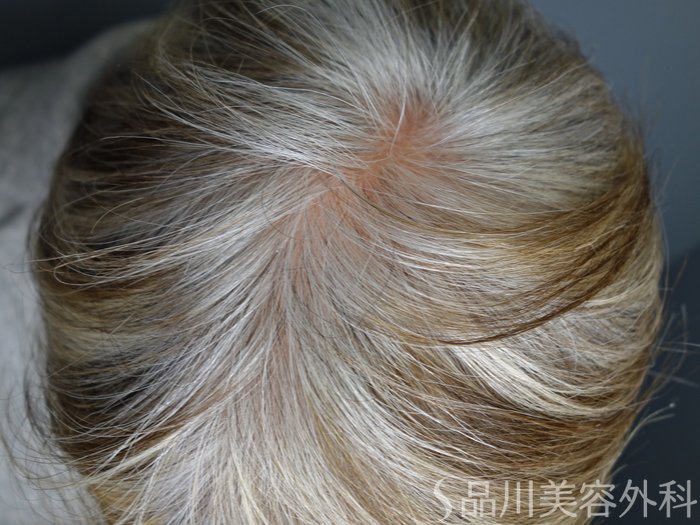 症例NO.73400のAFTER写真