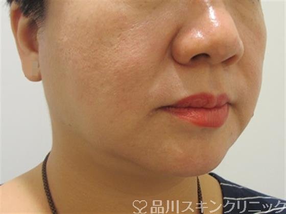 症例NO.33044のAFTER写真
