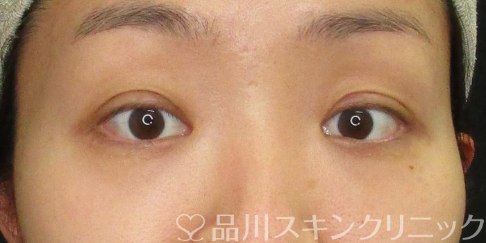 症例NO.70571のAFTER写真