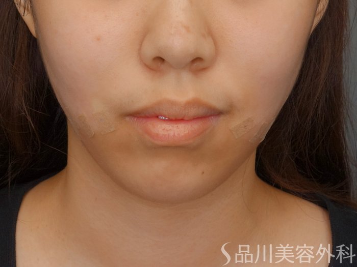 症例NO.71603のAFTER写真