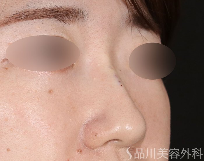 症例NO.71672のAFTER写真