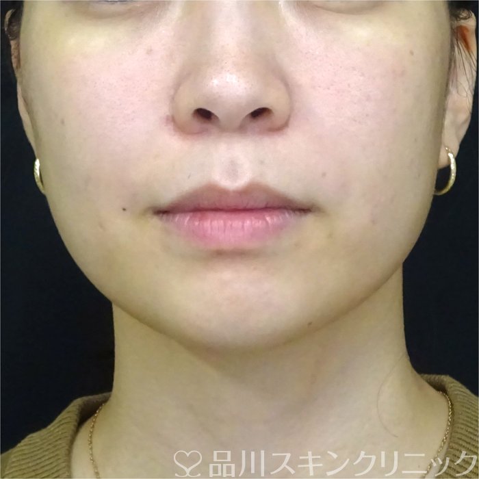 症例NO.71991のAFTER写真
