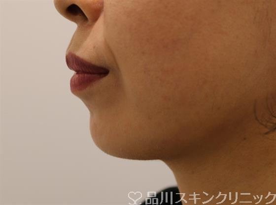 症例NO.44082のBEFORE写真