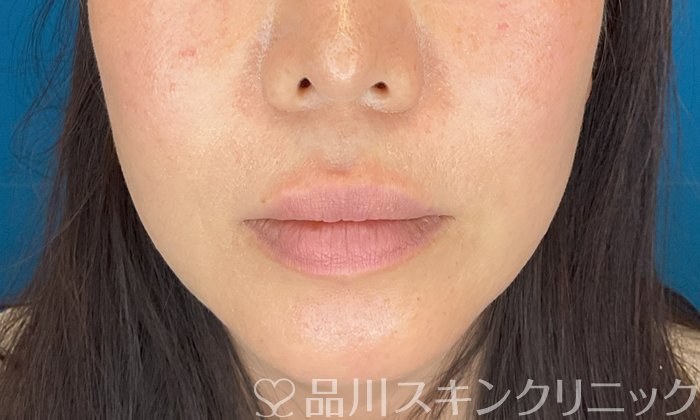 症例NO.74826のAFTER写真