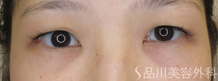 症例NO.70934のBEFORE写真