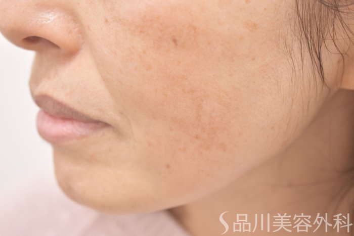 症例NO.64711のAFTER写真