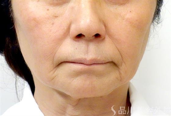 症例NO.28133のBEFORE写真