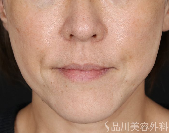 症例NO.71304のAFTER写真