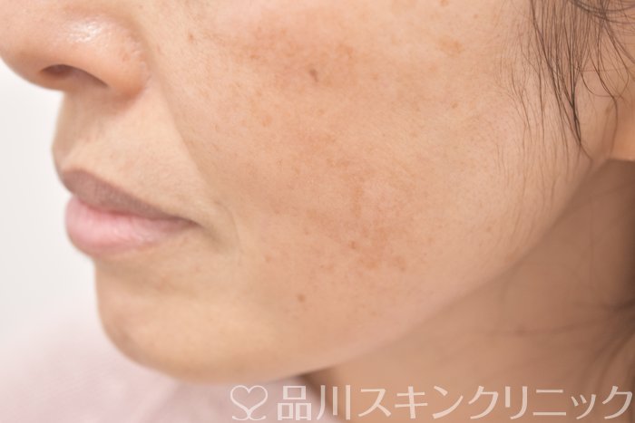 症例NO.64711のAFTER写真