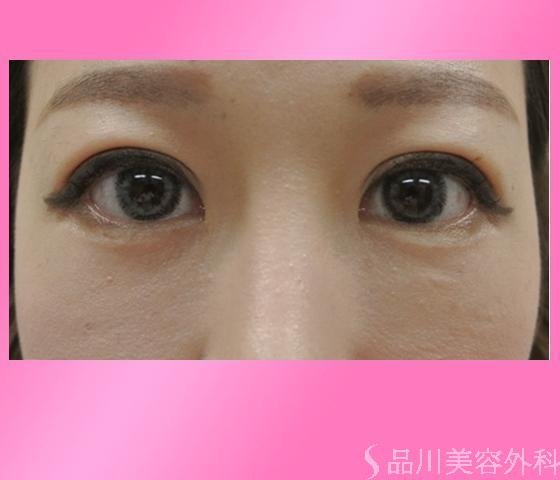 症例NO.14262のAFTER写真