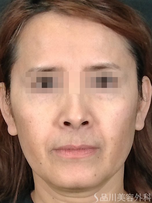 症例NO.70664のBEFORE写真