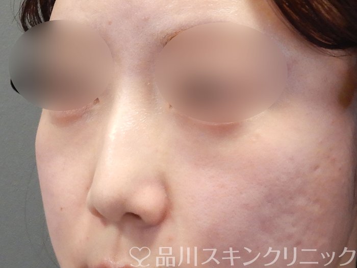 症例NO.72695のBEFORE写真