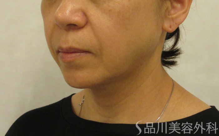 症例NO.72193のBEFORE写真