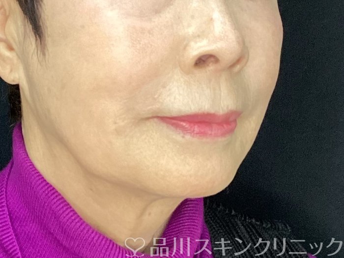 症例NO.73212のAFTER写真