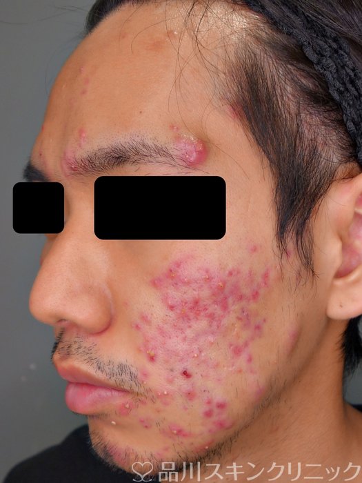 症例NO.73214のBEFORE写真