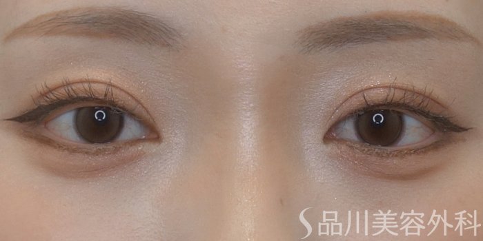 症例NO.73880のAFTER写真