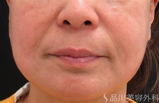 症例NO.56297のBEFORE写真