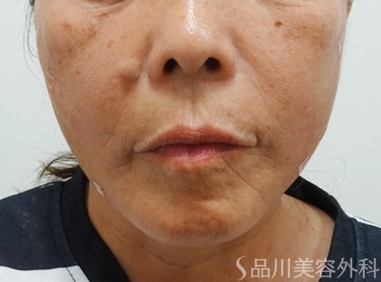 症例NO.73210のAFTER写真