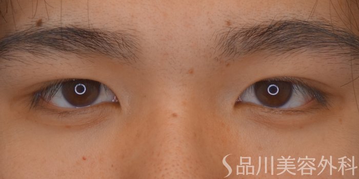 症例NO.69640のBEFORE写真