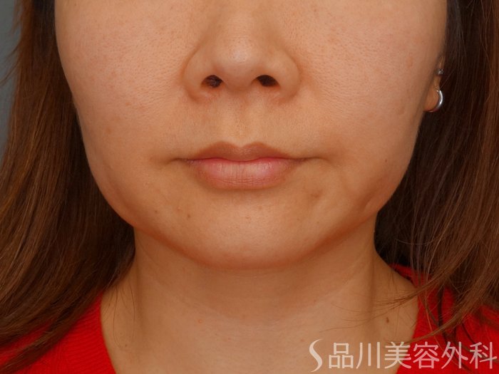 症例NO.62815のBEFORE写真