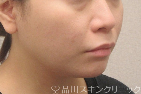 症例NO.72784のBEFORE写真