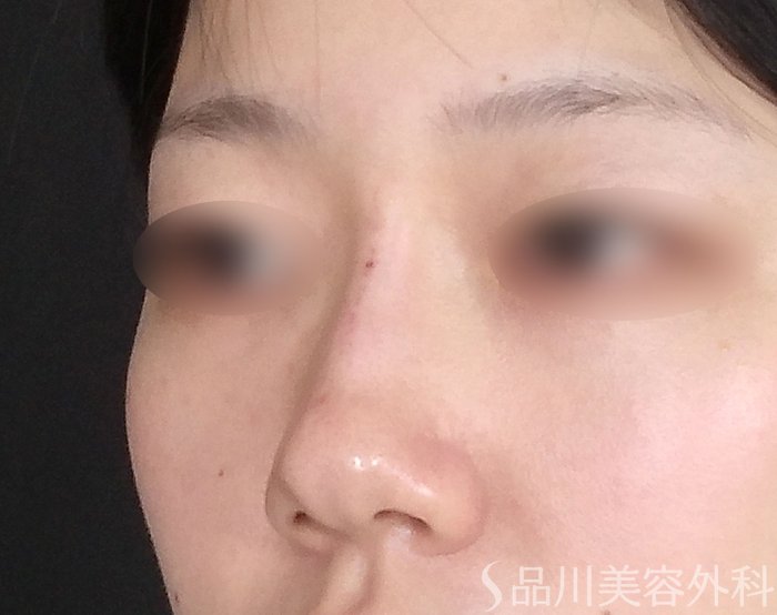 症例NO.65075のAFTER写真