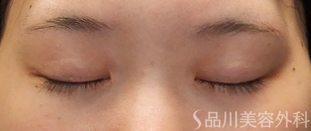 症例NO.71692のBEFORE写真