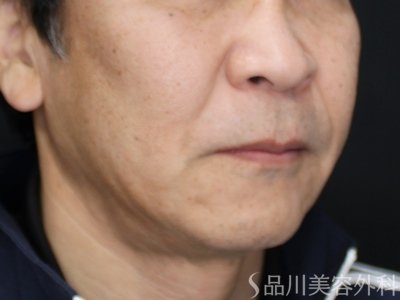 症例NO.73471のAFTER写真