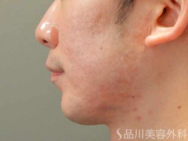 症例NO.72804のAFTER写真