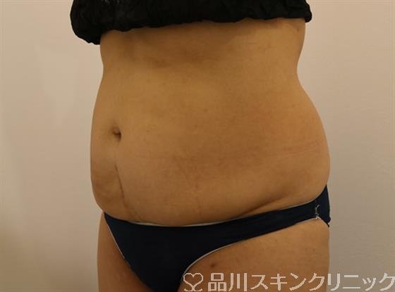 症例NO.44346のAFTER写真