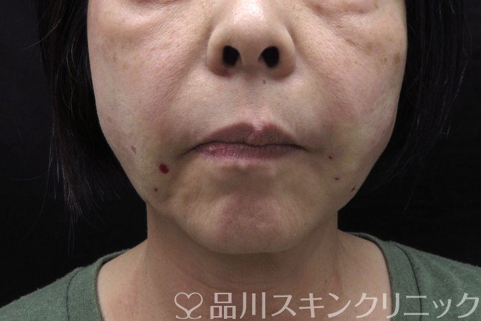 症例NO.74801のAFTER写真
