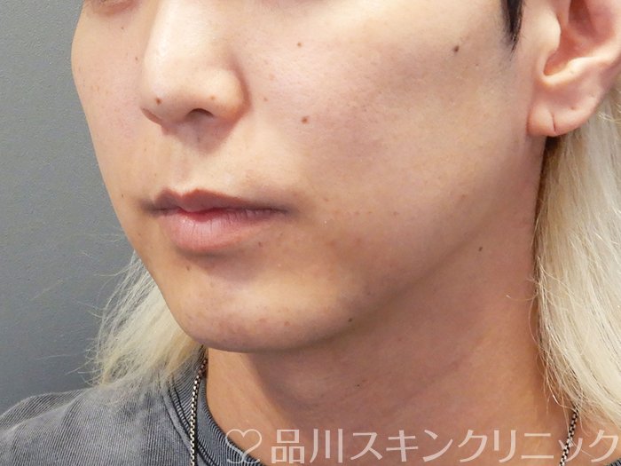 症例NO.74370のBEFORE写真