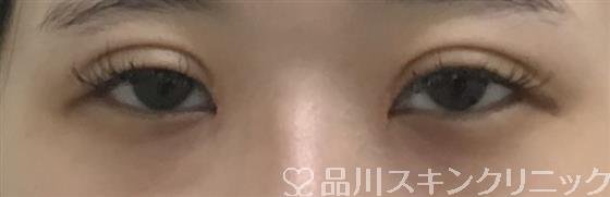 症例NO.46445のAFTER写真