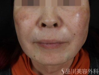 症例NO.73530のAFTER写真