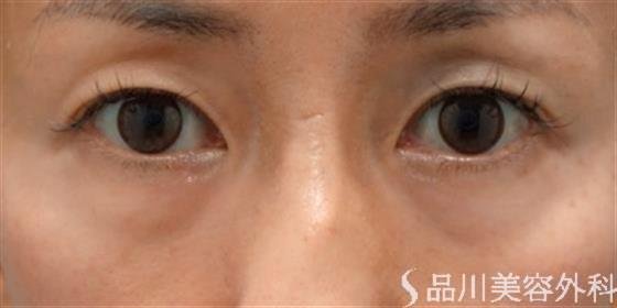 症例NO.51627のBEFORE写真