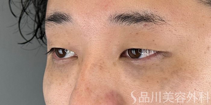 症例NO.72839のBEFORE写真