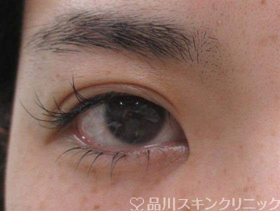 症例NO.26835のBEFORE写真