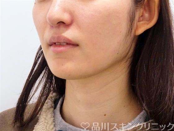 症例NO.48938のAFTER写真