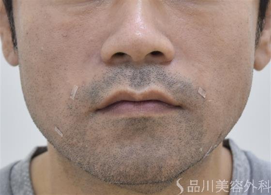 症例NO.43957のAFTER写真