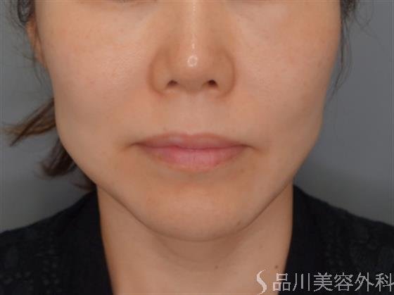 症例NO.52792のBEFORE写真