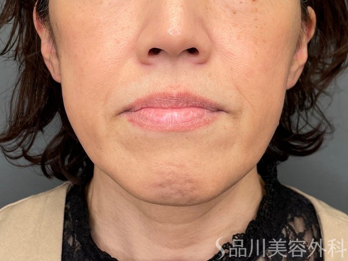 症例NO.65429のBEFORE写真