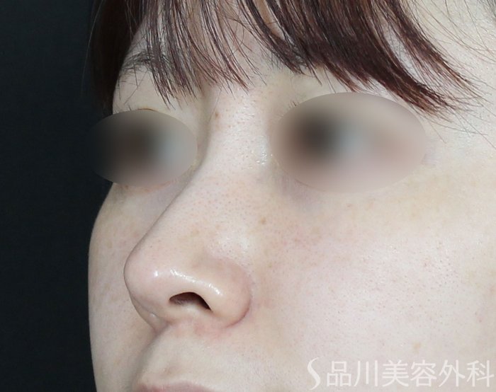 症例NO.65664のBEFORE写真
