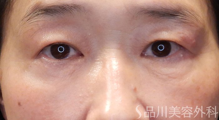 症例NO.70528のAFTER写真