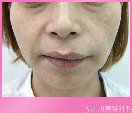 症例NO.1171のBEFORE写真