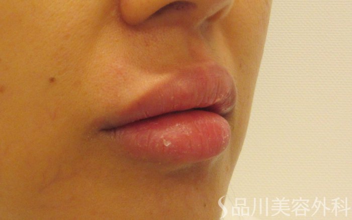 症例NO.70844のAFTER写真