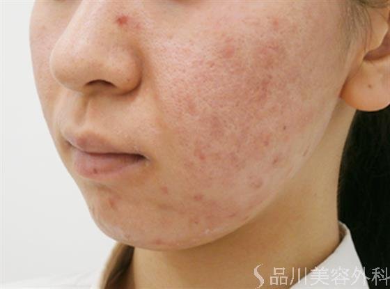 症例NO.30674のBEFORE写真
