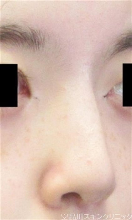 症例NO.59752のBEFORE写真
