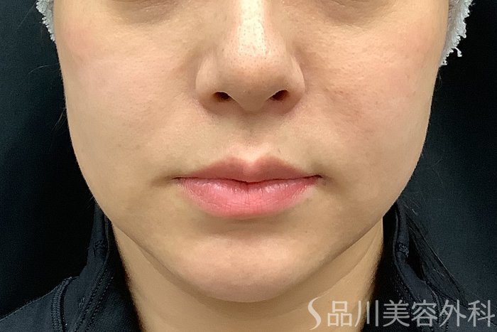 症例NO.73313のBEFORE写真